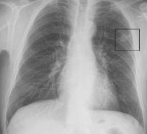 Lung cancer as seen on X-ray